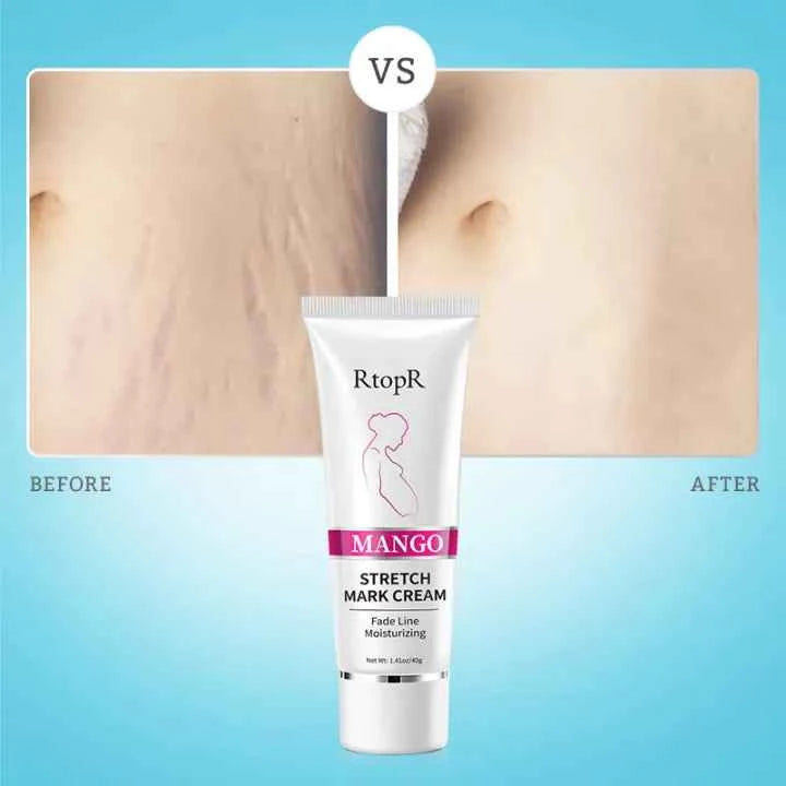 RtopR Mango Anti-Stretch Mark Cream: Natural Prenatal & Postnatal Skin Smoothing Lotion for Moms