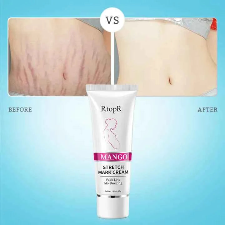 RtopR Mango Anti-Stretch Mark Cream: Natural Prenatal & Postnatal Skin Smoothing Lotion for Moms