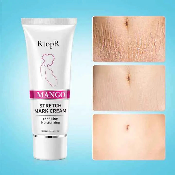 RtopR Mango Anti-Stretch Mark Cream: Natural Prenatal & Postnatal Skin Smoothing Lotion for Moms