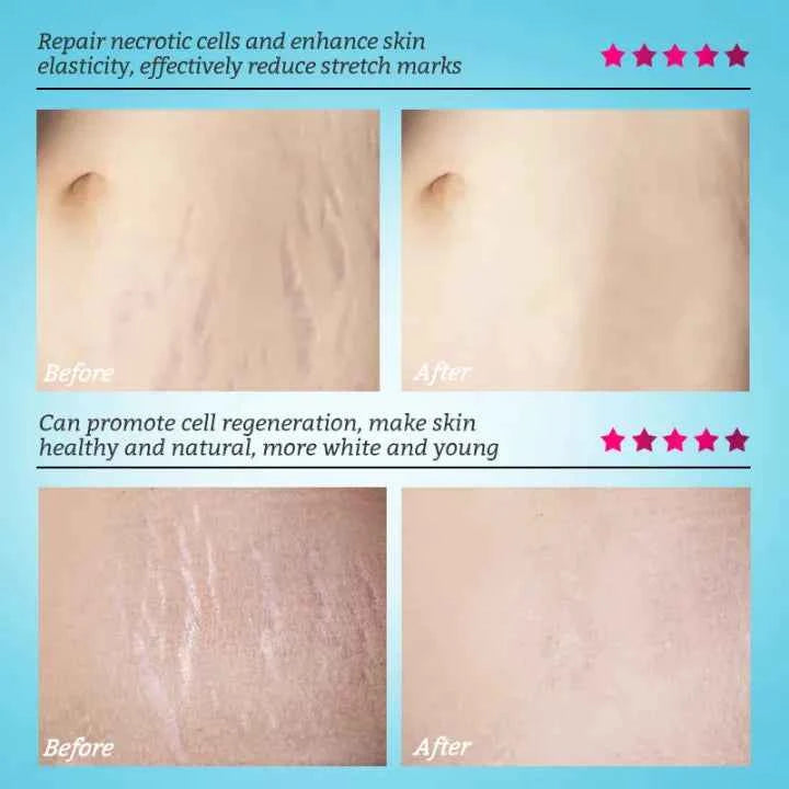 RtopR Mango Anti-Stretch Mark Cream: Natural Prenatal & Postnatal Skin Smoothing Lotion for Moms